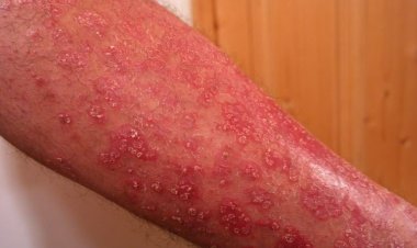 Primul caz de variola maimuţei a fost identificat în Italia