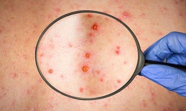 Alexandru Rafila, sfaturi pentru evitarea contaminării cu variola maimuței