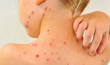 Ministerul Sănătăţii a declarat epidemie de rujeolă la nivel naţional
